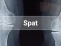 Röntgenaufnahme zeigt das Endstadium von Spat bei einem Pferd, mit deutlichen knöchernen Veränderungen im Sprunggelenk.