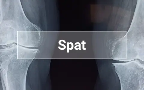 Röntgenaufnahme zeigt das Endstadium von Spat bei einem Pferd, mit deutlichen knöchernen Veränderungen im Sprunggelenk.