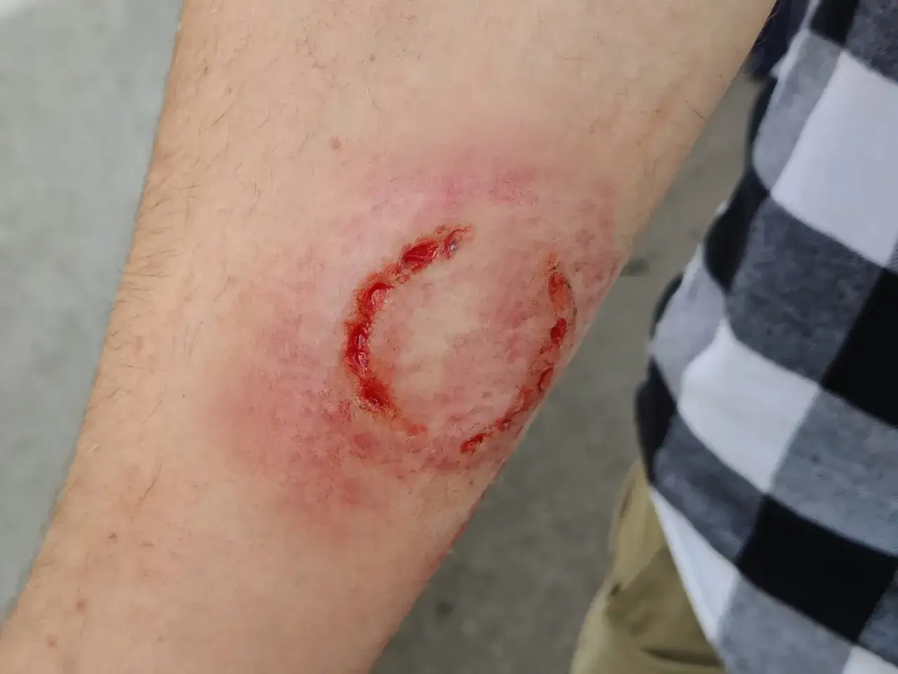 Verletzung am Arm, die wie ein Pferdebiss aussieht. Rötung und blutige Wunden im Kreis. Was tun bei einem Pferdebiss?